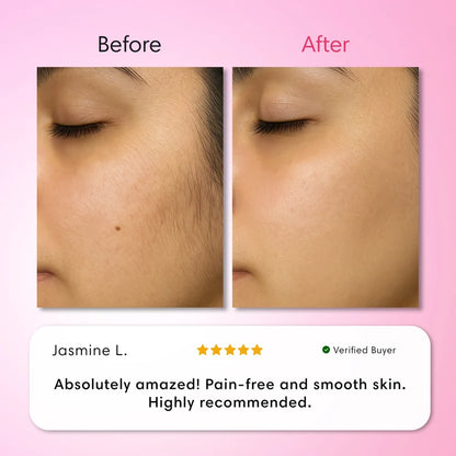 Hair Removal Trilogy Kit