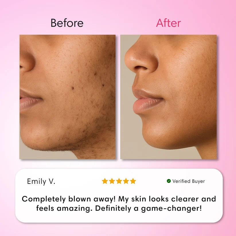 Hair Removal Trilogy Kit